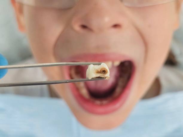 Best Emergency Wisdom Teeth Removal in The Hammocks, FL